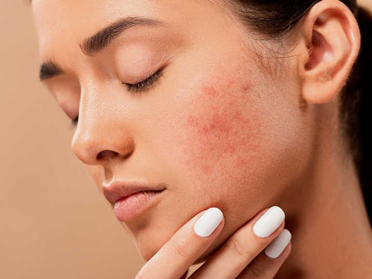 closeup of woman's face with allergies